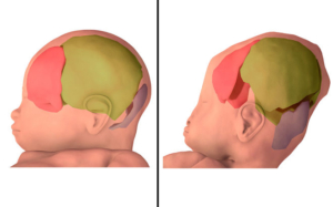 kepala bayi cranio lonjong fontanelle orami parto kembali nascituro livescience bisakah lahir saat bones babys while squished skulls triglycerides fatty
